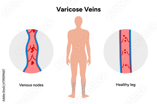 Varicose veins, venous nodes, healthy leg