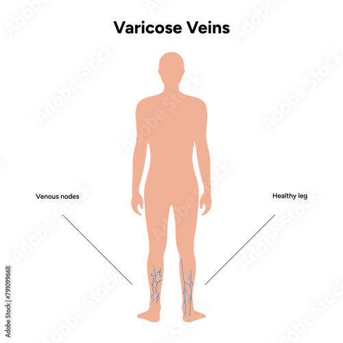 Varicose veins, healthy leg