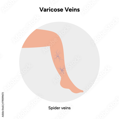Varicose veins, spider veins