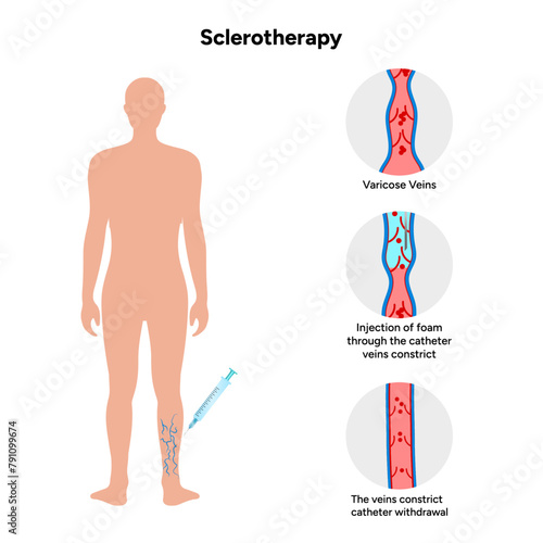 Normal and Varicose vein treatment, Sclerotherapy 