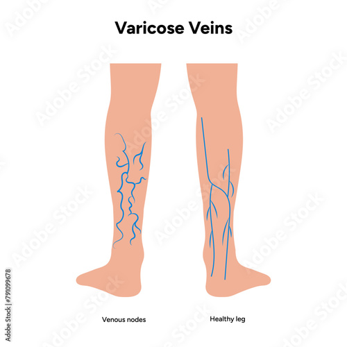 Varicose veins, venous nodes, healthy leg