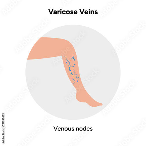 Varicose veins, venous nodes