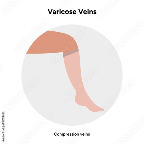 Varicose veins, compression stocking