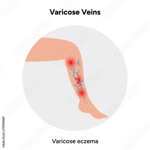Varicose veins, varicose eczema 