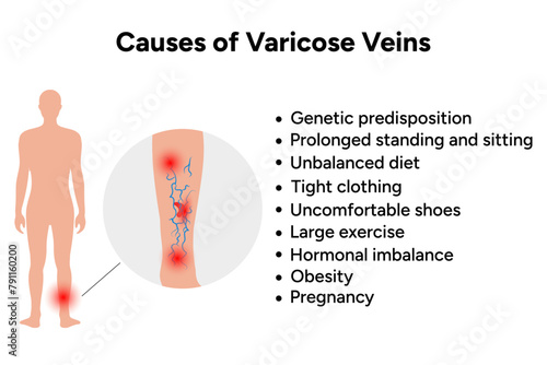 Causes of varicose veins, medical information 