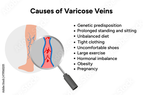 Causes of varicose veins