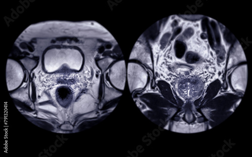 MRI of the prostate gland reveals Focal abnormal SI lesion at left PZpl at apex as described; PI-RADS category 4, clinically