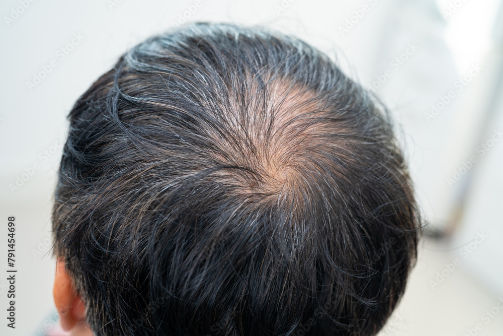 Bald in the middle head and begin no loss hair glabrous of mature Asian business smart active office man. Bald in the middle head and begin no loss hair glabrous of mature Asian business smart active office man.