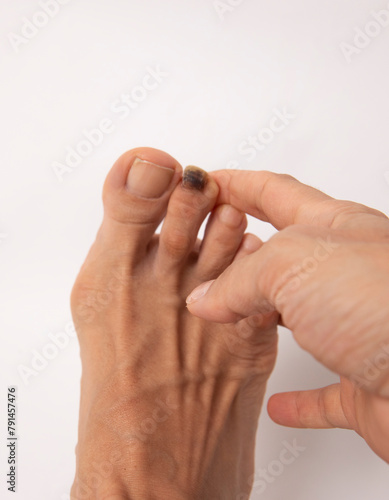 people, person, model health, healthy, healthcare, care, medical people, person, model health, healthy, healthcare, care, closeup, close cutout, cut out foot  finger foot fungus foot health