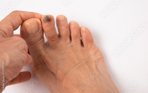 people, person, model health, healthy, healthcare, care, medical people, person, model health, healthy, healthcare, care, closeup, close cutout, cut out foot  finger foot fungus foot health