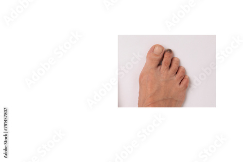 people, person, model health, healthy, healthcare, care, medical people, person, model health, healthy, healthcare, care, closeup, close cutout, cut out foot  finger foot fungus foot health
