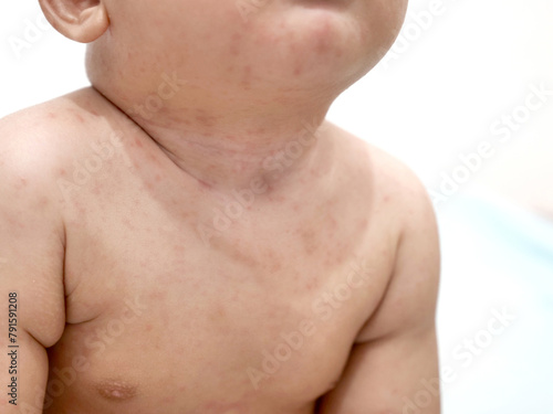 Baby girl with red rash on her skin, measles or chicken pox on newborn