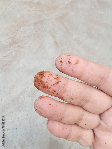Brown stains on fingers are caused by scales of potassium permanganate, a potassium permanganate with the properties of a weak base salt. If exposed to large amounts, the skin becomes dry and flaky.
