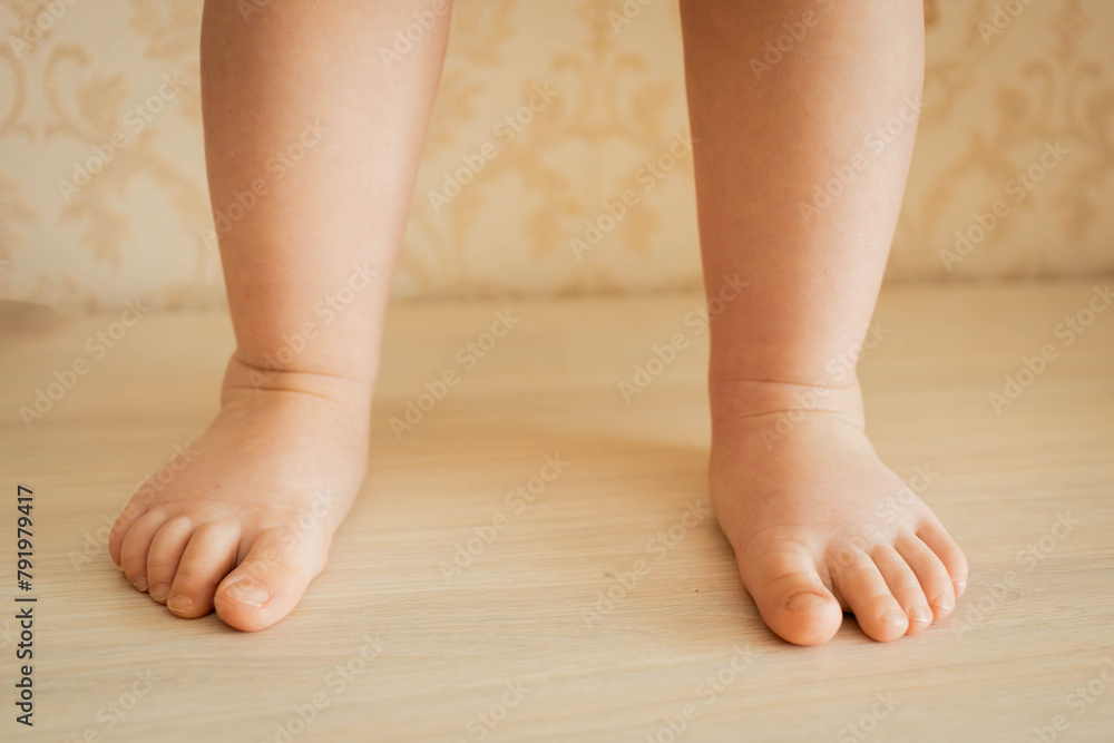 hallux valgus in a child