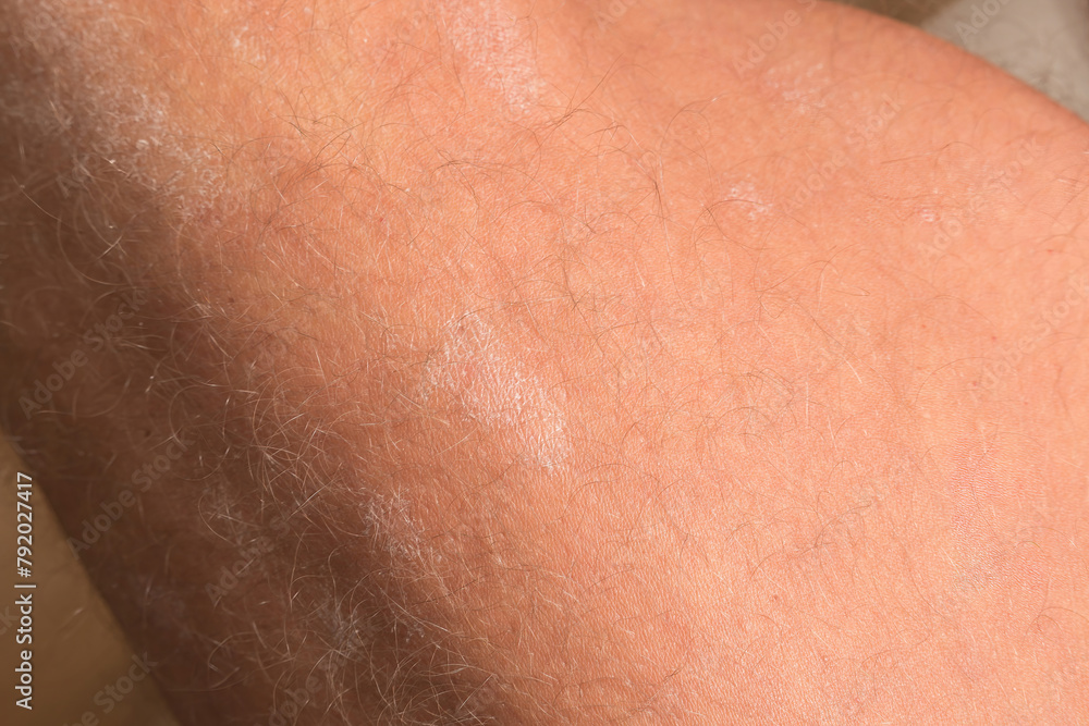 Fototapeta premium Large plaque parapsoriasis on caucasian man legs