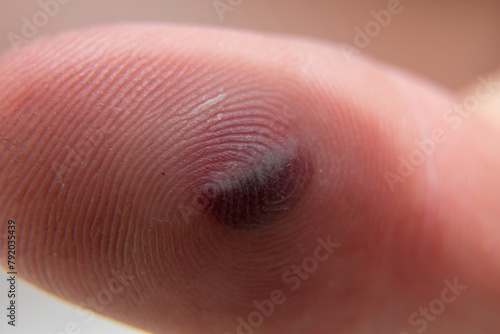 Blood blister under the thumb skin. Caucasian young man finger on white background.
