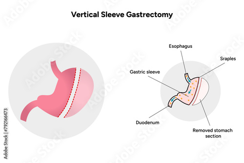 Vertical Sleeve Gastrectomy 