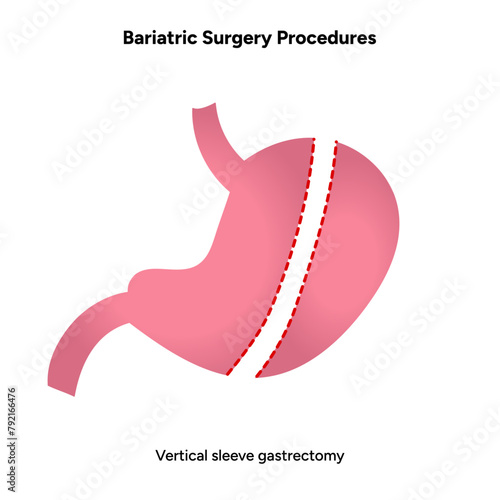 Vertical Sleeve Gastrectomy 