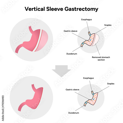 Vertical Sleeve Gastrectomy 
