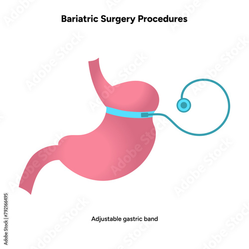 Bariatric Surgery procedures