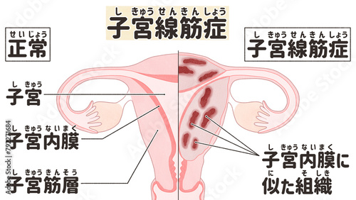 Adenomyosis labeled diagram; Normal and adenomyotic uterus PNG photo
