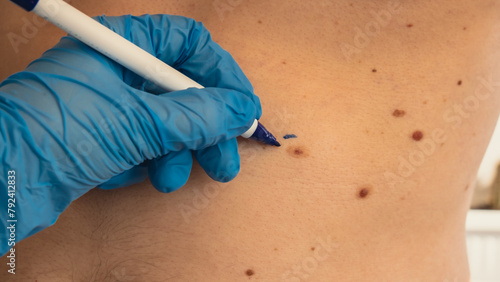 Quadro su tela Doctor in medical gloves paint lines around male birthmarks