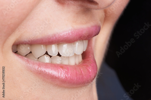 Obraz na płótnie Macro photography of teeth with beautiful lips, showcasing veneers. w salonie