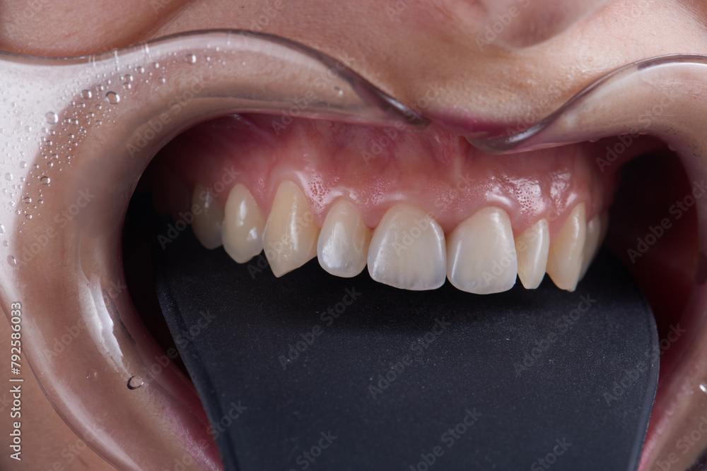 Macro photography of teeth with veneers