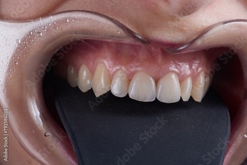 Obraz na płótnie Macro photography of teeth with veneers w salonie