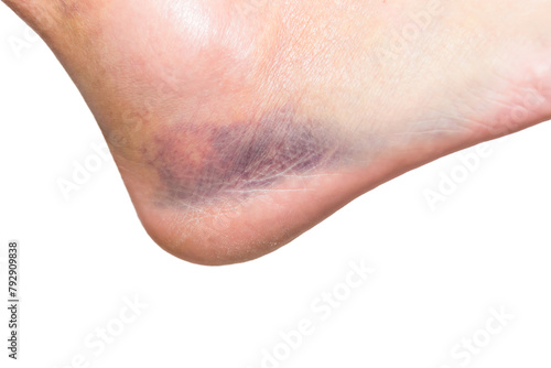 close up of heel with injury, sprain, strain, inflammation, bruise, kinesiology