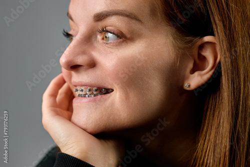 Canvastavla European woman with braces on her teeth smiles carefree