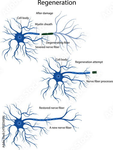 An attempt at nerve fiber regeneration. Damage and degeneration of the nerve fiber.
