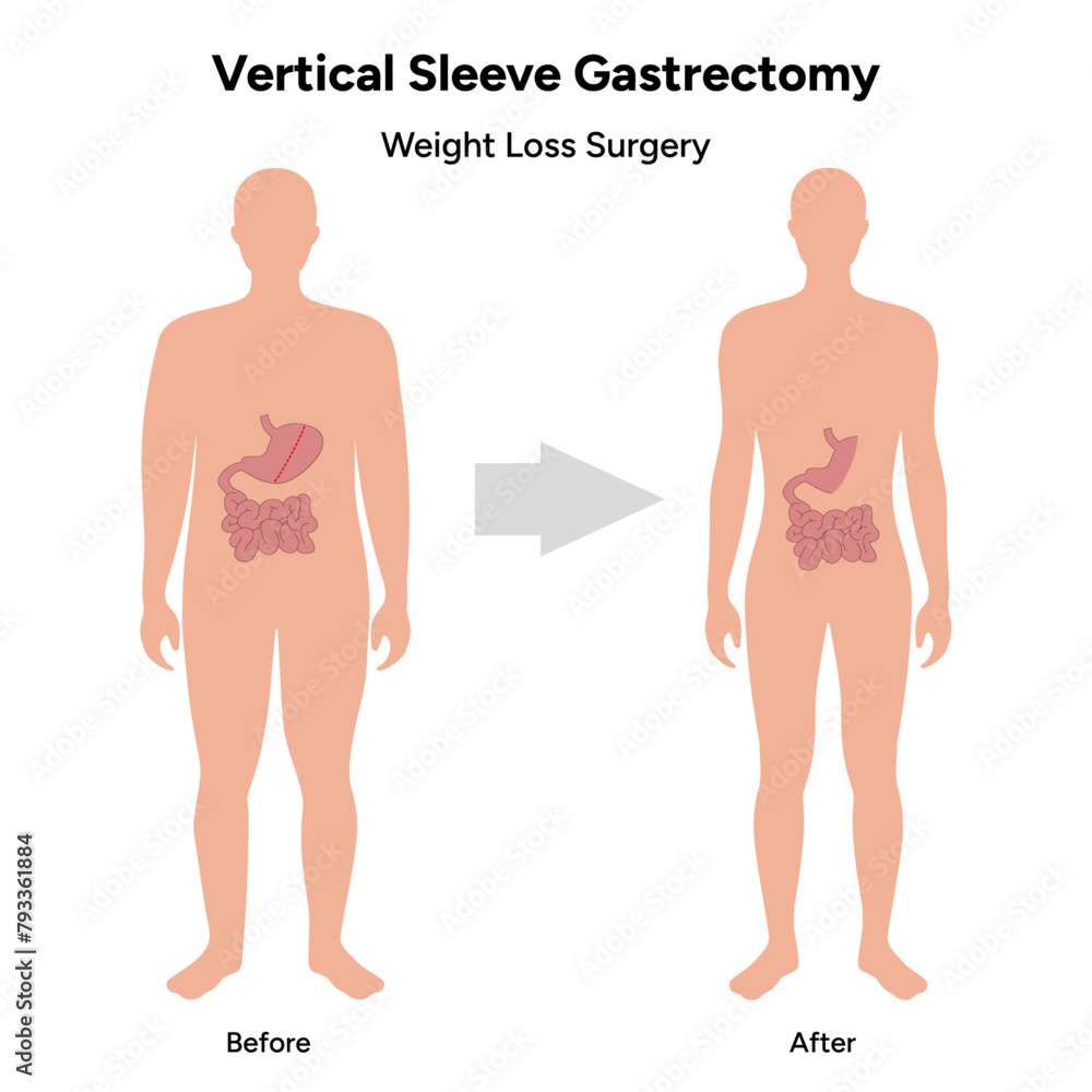 Vertical Sleeve Gastrectomy Weight loss surgery Vertical Sleeve Gastrectomy Weight loss surgery