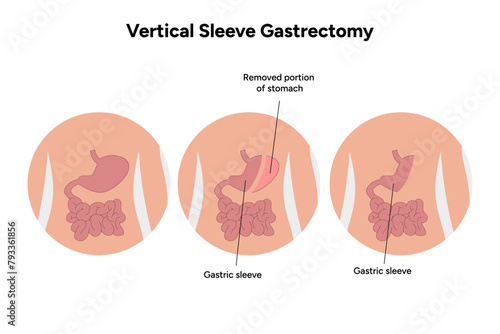 Vertical Sleeve Gastrectomy before and after, Gastric photo