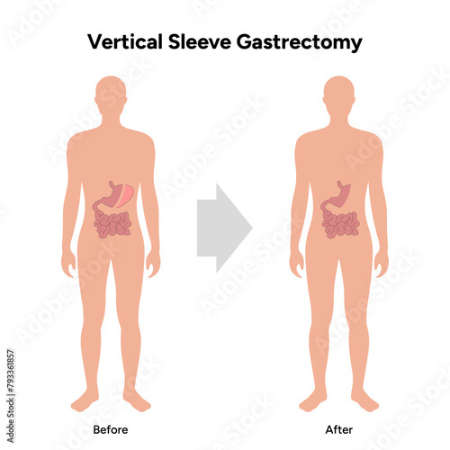 Vertical Sleeve Gastrectomy before and after, Gastric