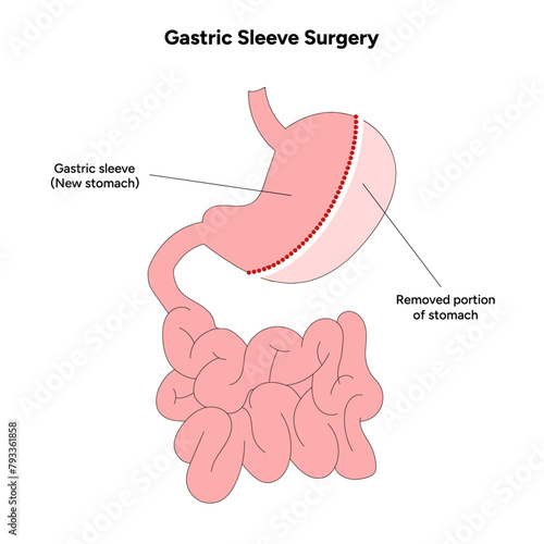 Gastric Sleeve Surgery 