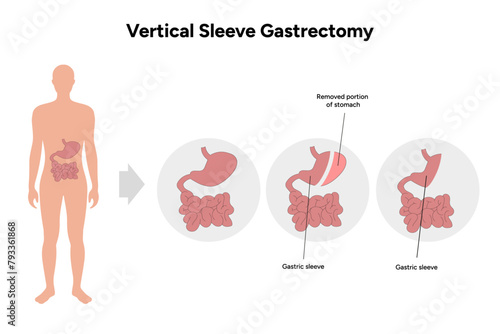 Vertical Sleeve Gastrectomy before and after