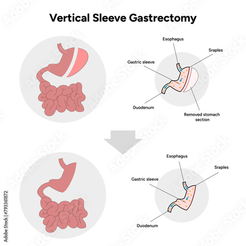 Vertical Sleeve Gastrectomy before and after
