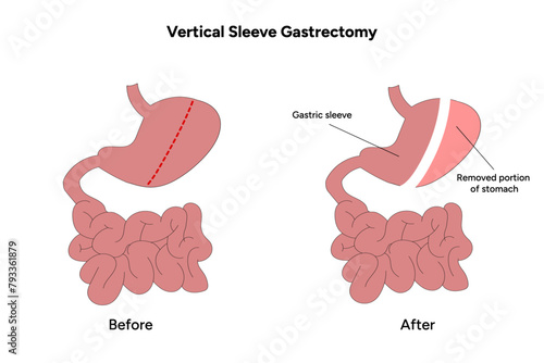 Vertical Sleeve Gastrectomy before and after