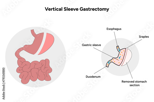 Vertical Sleeve Gastrectomy, medical infographic 
