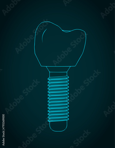 Dental prosthesis blueprint