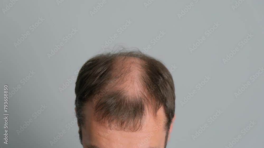 Man with hair loss problems close-up. Close-up of a young man with alopecia on a gray background. Man with hair loss problems close-up. Close-up of a young man with alopecia on a gray background.