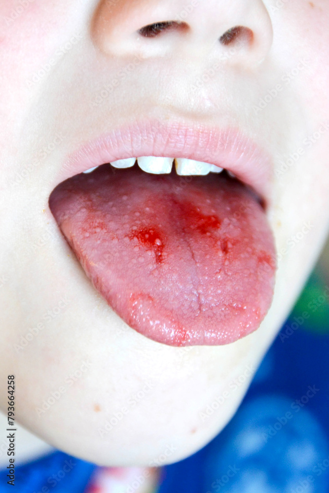 Obraz premium Close-up of lips, tongue, protrusion of blood. Child's bitten tongue.
