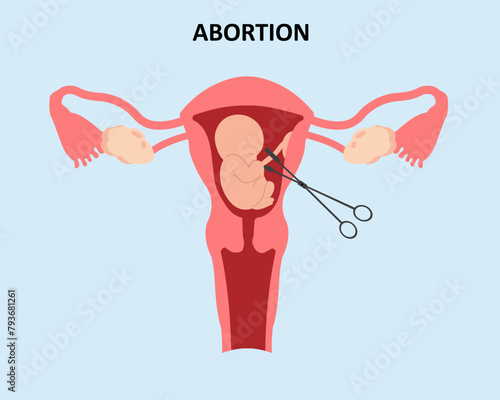 An embryo in the womb and surgical forceps Miscarriage abortion loss pregnancy vector illustration