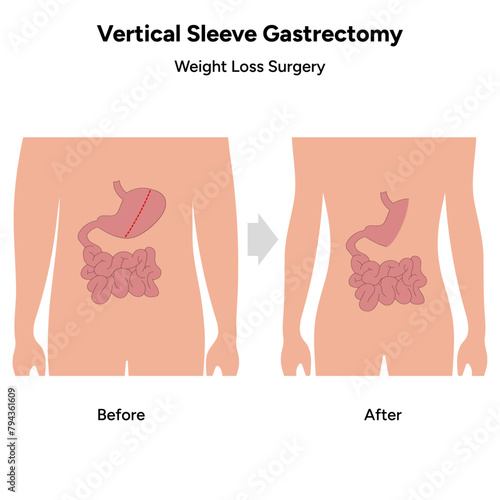 Vertical Sleeve Gastrectomy before  and after