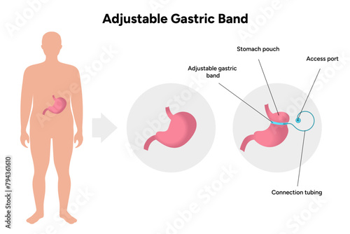 Adjustable Gastric Band, medical infographic, before after