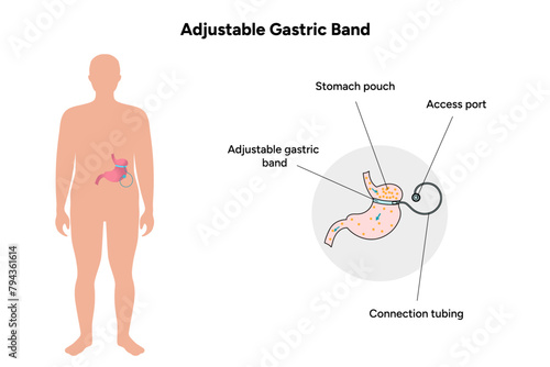 Adjustable Gastric Band, medical infographic 