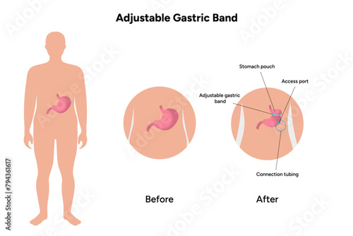 Adjustable Gastric Band, medical infographic 