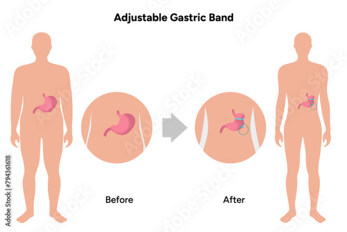 Adjustable Gastric Band, medical infographic, before after
