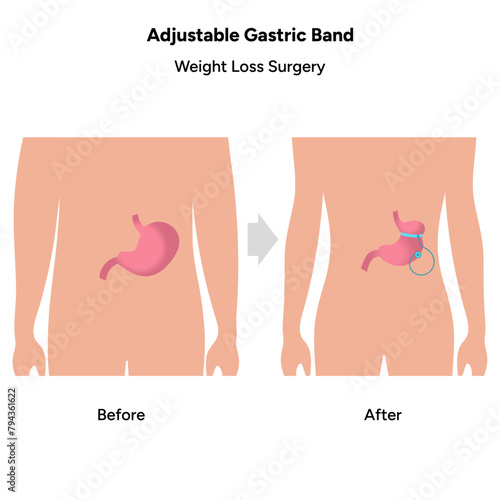 Adjustable Gastric Band, medical infographic, weight loss surgery 